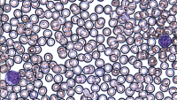 Cancer cells are significantly reduced after ATRA treatment which blocks a faulty β-catenin signal in the bone marrow that helps leukemia grow.